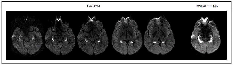 The figure above is a scan showing diffusion-weighted imaging findings at the initial brain magnetic resonance imaging of a patient with unusual amnestic syndrome in Massachusetts during 2012.