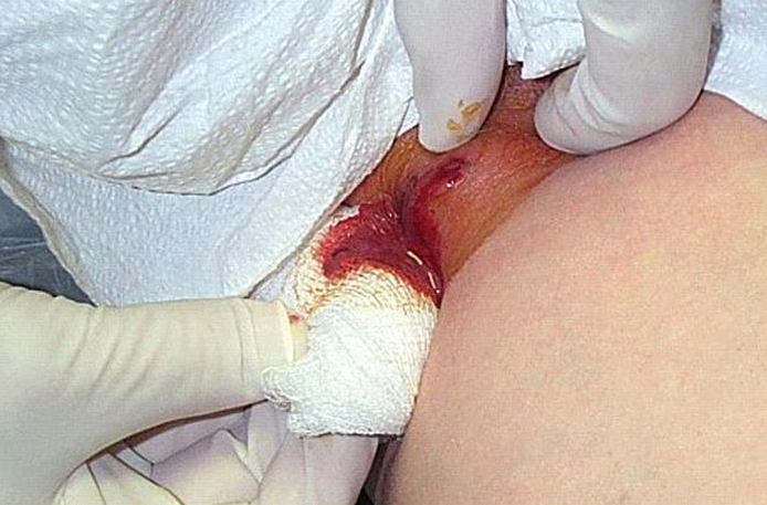 Cutaneous abscess located on the thigh