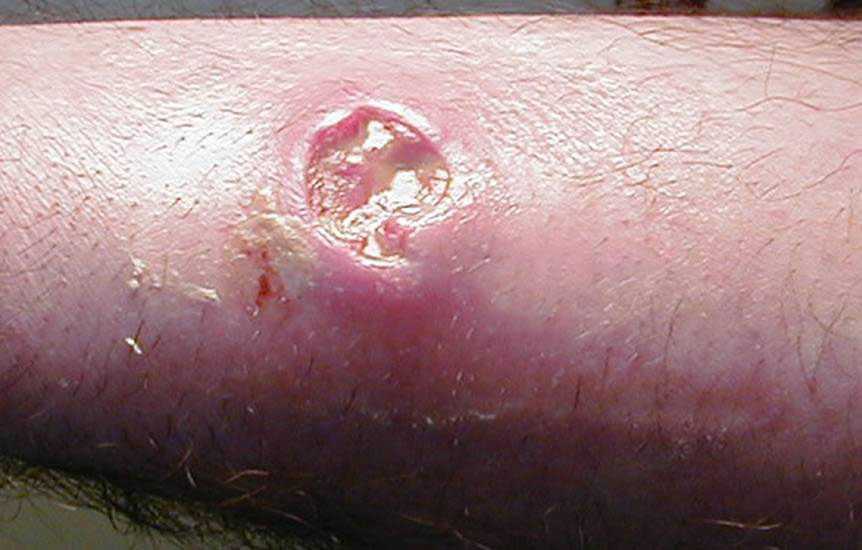 Photograph depicted a cutaneous abscess,  caused by MRSA
