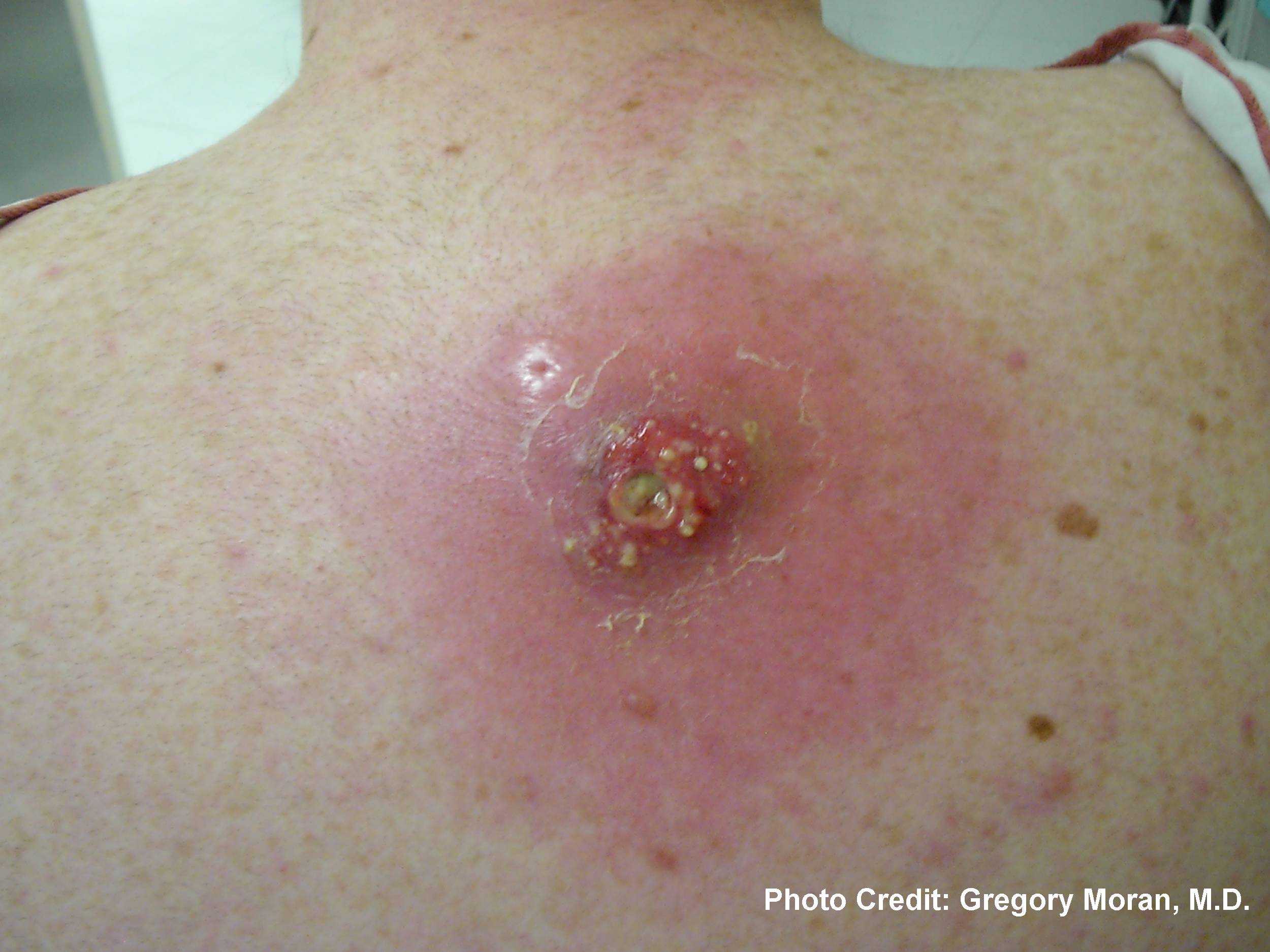 Cutaneous abscess located on the back