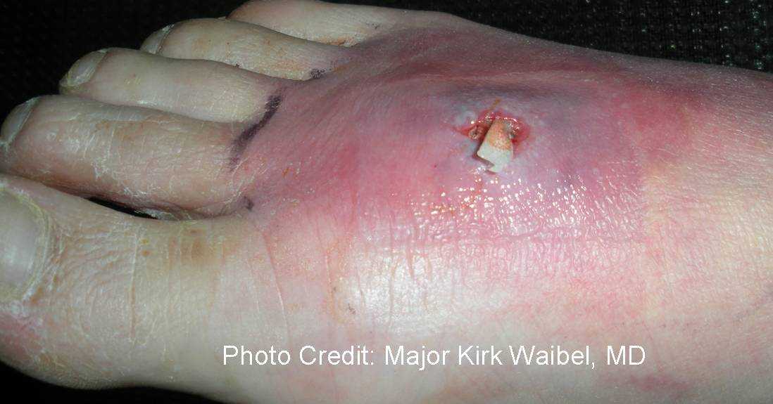 Cutaneous abscess on the foot post packing (side view)