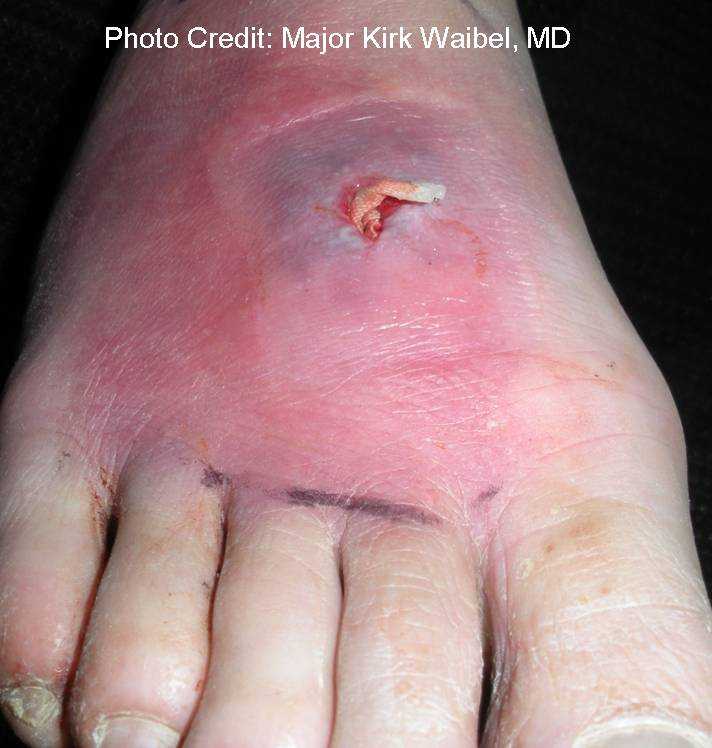 Photograph depicted a cutaneous abscess on the foot post packing (side view)