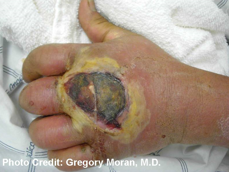 Photograph depicted a cutaneous abscess,  caused by MRSA