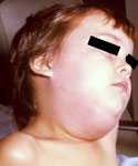 Child with mumps.