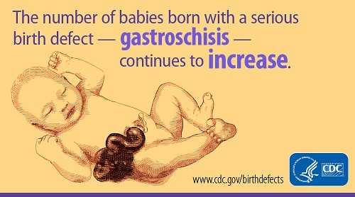 The number of babies born with a serious birth defect - gastroschisis - continues to increase.