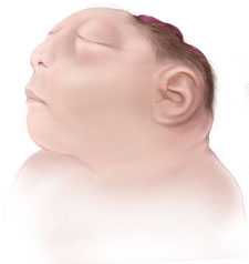 Picture of Anencephaly