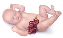 Baby with gastroschisis