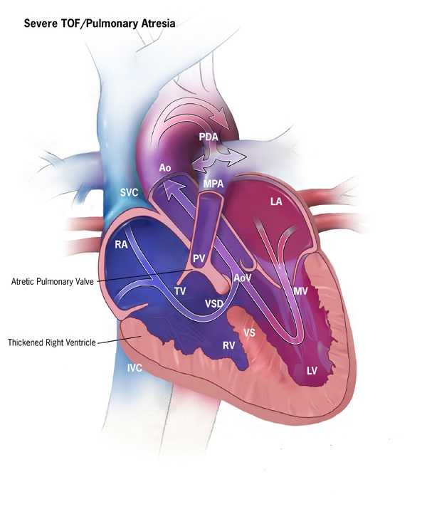 Pulmonary Atresia with Ventricular Septal Defect