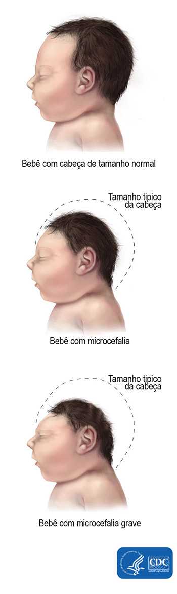 Bebê com cabeça de tamanho normal, Bebê com microcefalia, Bebê com microcefalia grave