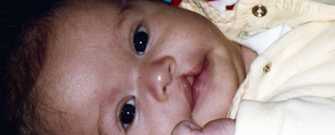 Infant with cleft lip