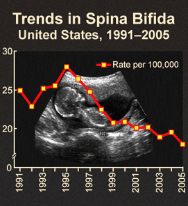 Trends in Spina Bifida, US 1991-2005