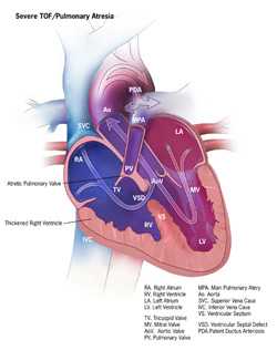 Severe TOF / Pulmonary Atresia