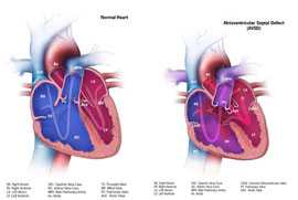 Graphic: Atrioventricular Septal Defect (AVSD) with a normal heart