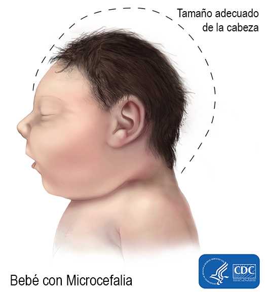 BebÃ© con microcefalia