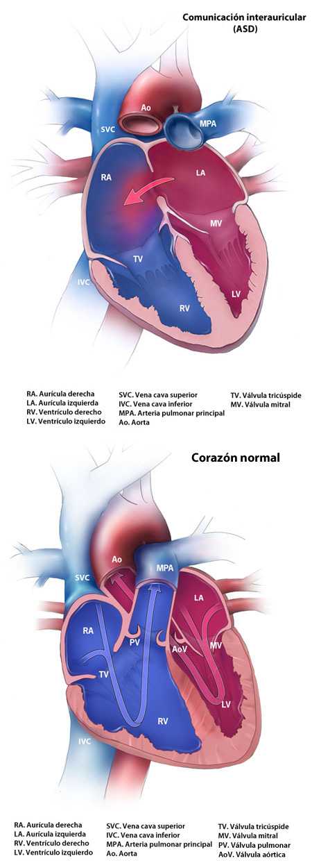 	Normal Heart and Atrial Septal Defect