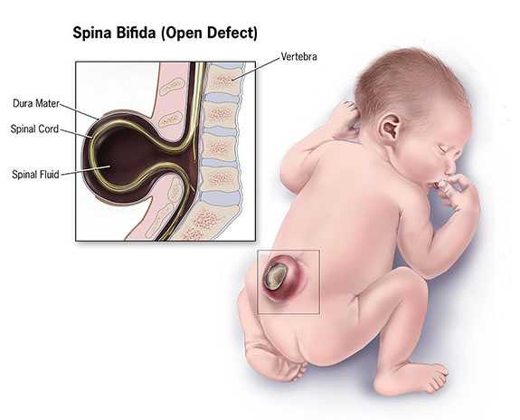 Spina Bifida open defect with labels for the verteba, dura matter, spinal cord, and spinal fluid
