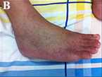 Picture of foot showing a rash of red dots