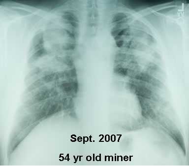 An x-ray of pneumoconiosis.