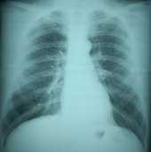 	Normal Chest Radiograph