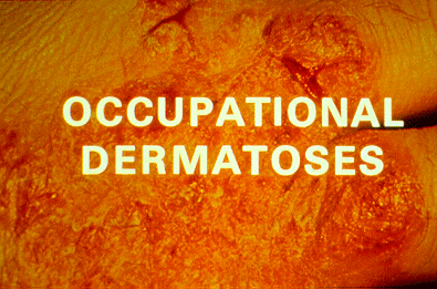 	Occupational Dermatoses - Title Slide