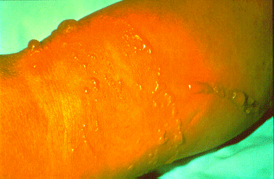 	SLIDE 18 - Contact Dermatitis, Acute