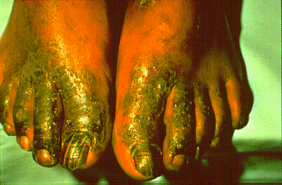 	SLIDE 19 - Contact Dermatitis, Subacute