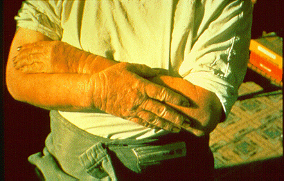 	SLIDE 20 - Contact Dermatitis, Chronic