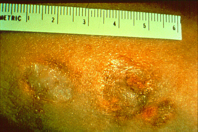 	SLIDE 24 - Granuloma