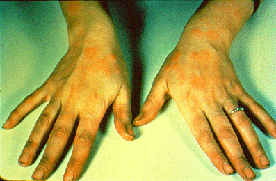 	SLIDE 37 - Solvent, nummular eczema