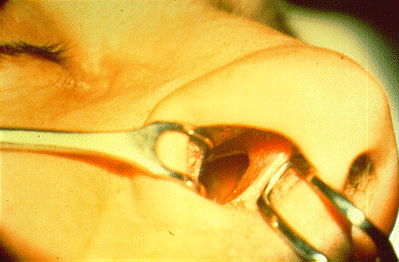 	SLIDE 39 - Chrome hole, nasal