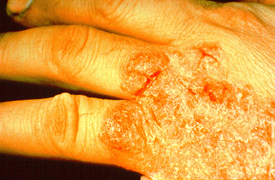 	SLIDE 41 - Cutting fluids, eczematous