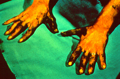 	SLIDE 56 - Stained hands in foundry worker
