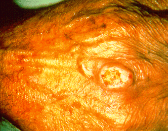 	SLIDE 70 - Squamous cell epithelioma