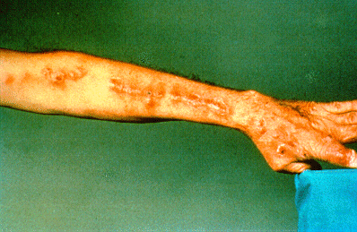 	SLIDE 73 - Sporotrichosis