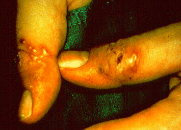 	SLIDE 76 - Herpetic fingers