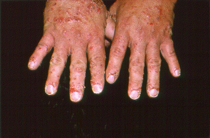 	SLIDE 117 - Irritant Contact Dermatitis from Fiber Glass