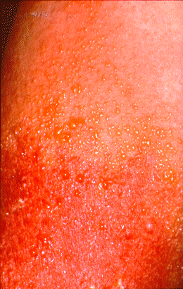 	SLIDE 119 - Rhus Dermatitis