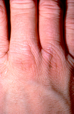 	SLIDE 121 - Chromate Dermatitis