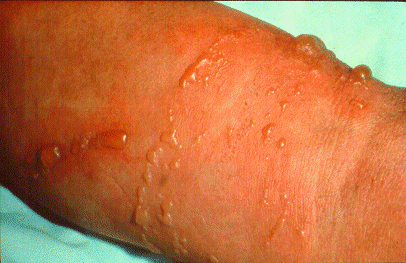 	SLIDE 123 - Ethylene Oxide Dermatitis