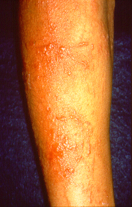 	SLIDE 125 - Allergic Plant Dermatitis