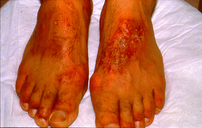 	SLIDE 127 - Allergic Shoe or Work Boot Dermatitis