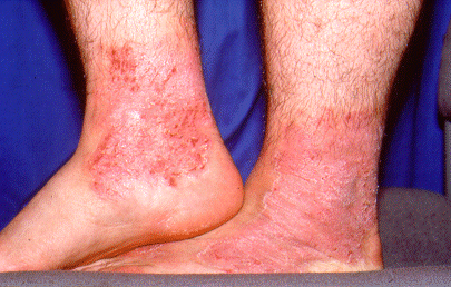 	SLIDE 128 - Work Boot Dermatitis on Ankles