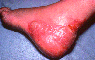 	Slide 129 - Shoe Dermatitis