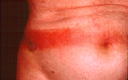 	SLIDE 131 - Elastic Dermatitis (allergy to bleached rubber)