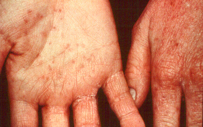 	SLIDE 133 - Contact Urticaria Syndrome to Raw Fish