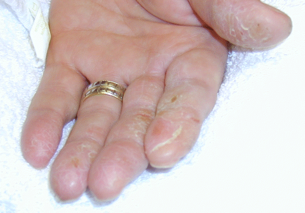 	SLIDE 137 - Optician - non-dominant hand dermatitis (allergy to ethyl acrylate)