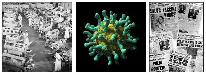 Photos of polio virus, newspaper headlines of the day, and sick bay full of Polio patients.