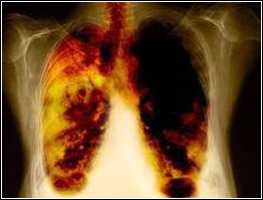 Photo of chest x-ray showing damage brought on by cigarette smoking