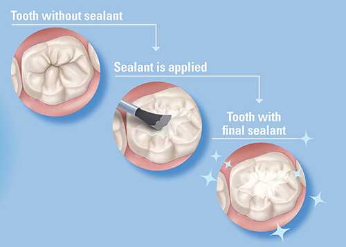 Image depicting teeth in the following sequence: Tooth without sealant; Sealant is applied; tooth with final sealant