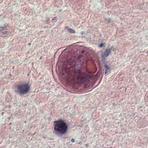 Cyst of Balamuthia mandrillaris in brain tissue. 